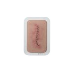 Pocketwound Surgical Wound Closed and Inflamed