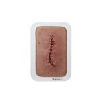 Pocketwound Surgical Wound Closed and Inflamed
