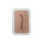 Pocketwound Surgical Wound Perfect