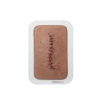 Pocketwound Surgical Wound Perfect
