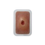 Pocketwound Keratinization - clean