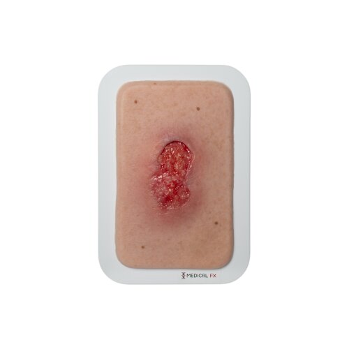 Pocketwound Granulation with Undermining