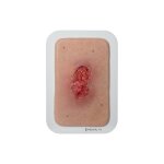 Pocketwound Granulation with Undermining