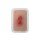 Pocketwound Granulation with Undermining