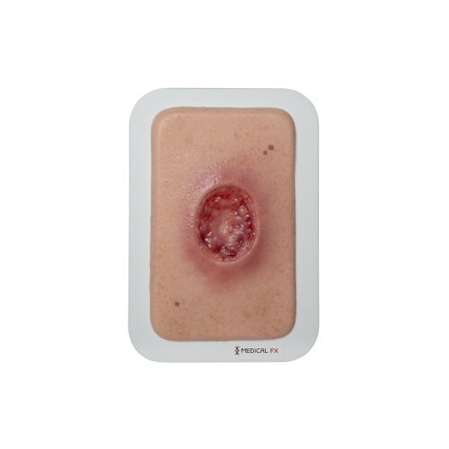 Pocketwound Surgical Wound (MOHS)