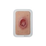 Pocketwunde Chirurgische Wunde (MOHS)