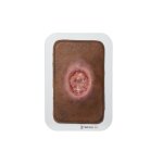 Pocketwunde Chirurgische Wunde (MOHS)
