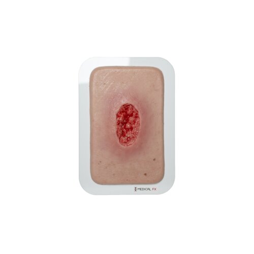 Pocketwound Hypergranulation deep