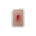 Pocketwound Hypergranulation deep