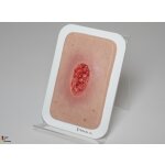 Pocketwound Hypergranulation deep