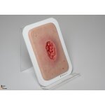 Pocketwound Hypergranulation deep