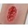 Pocketwound Hypergranulation deep