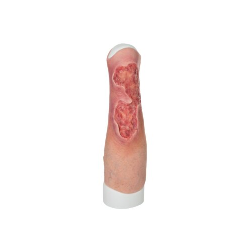 Sleeve Bein mit Gamaschenulkus - saubere Wunde, hell