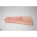 Sleeve Bein mit Gamaschenulkus - saubere Wunde, hell