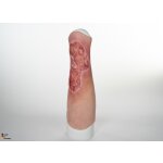 Sleeve Bein mit Gamaschenulkus - saubere Wunde, hell