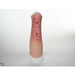 Sleeve Bein mit Gamaschenulkus - saubere Wunde, hell