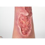 Sleeve Bein mit Gamaschenulkus - saubere Wunde, hell