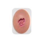 Stick-On Small Ulcer mit Unterminierung - saubere Wunde