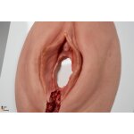 Stick-On Medium Fourth-Degree Perineal Tear