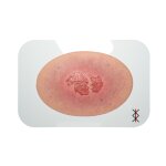 Stick-On Medium Dekubitus 2. Grades - saubere Wunde