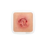 Rahmenmodell Ulcer mit Unterminierung