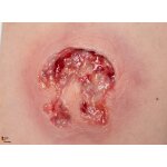 Rahmenmodell Ulcer mit Unterminierung