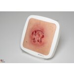 Rahmenmodell Ulcer mit Unterminierung