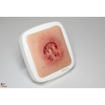 Rahmenmodell Ulcer mit Unterminierung