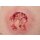 Rahmenmodell Ulcer mit Unterminierung