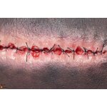 Stick-On Medium OP Wunde mit entz&uuml;ndeter Nahtdehiszenz - saubere Wunde