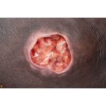 Stick-On Medium Pressure Ulcer Stage 3 - clean wound