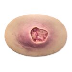 Stick-On Medium Pressure Ulcer Stage 3 - clean wound