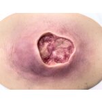 Stick-On Medium Pressure Ulcer Stage 3 - clean wound