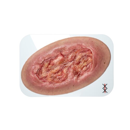 Stick-On Large Ulcer with Undermining - clean wound