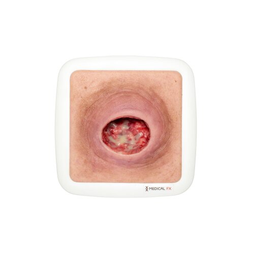 Frame Model Pressure Ulcer with Smooth Wound Edge - wound with coating