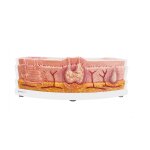 Frame Model Interactive Model of Hidradenitis Suppurativa
