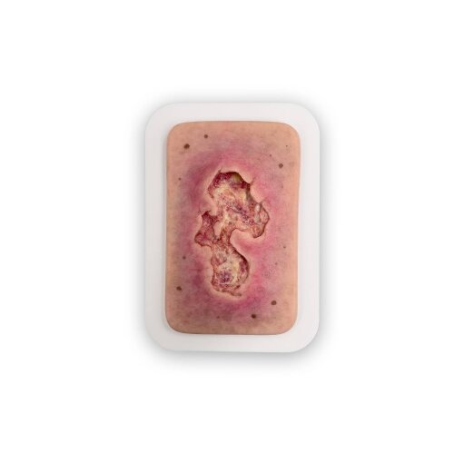Pocketwound Ulcer - Chronic Wound - wound with coating