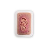 Pocketwound Ulcer - Chronic Wound - wound with coating