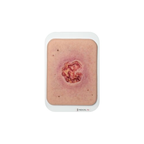 Pocketwound Ulcer with larger periwound skin area