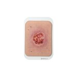 Pocketwound Ulcer with larger periwound skin area