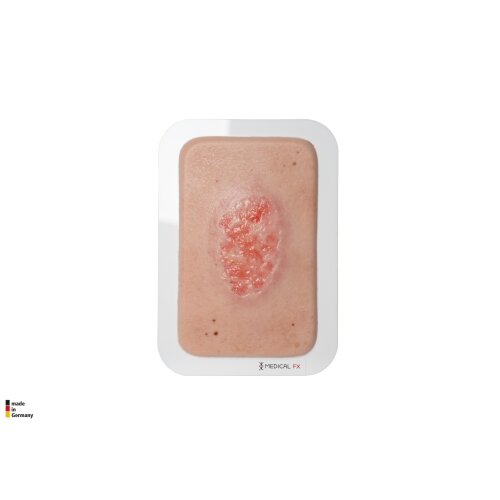 Pocketwunde Epithelisierung