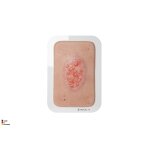 Pocketwunde Epithelisierung