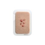 Pocketwunde Dermafibrom