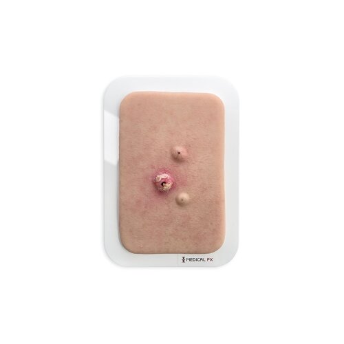 Pocket wound Epidermal inclusion cyst