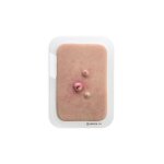 Pocketwunde Cysta epidermalis (Epidermalzyste)