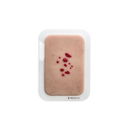 Pocket wound Hemangioma