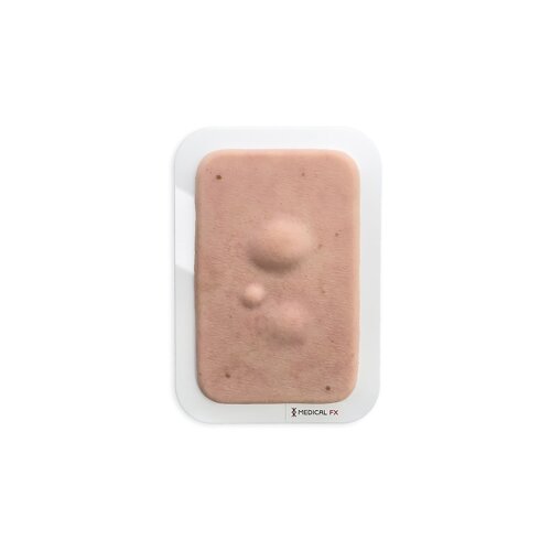 Pocketwunde Lipom