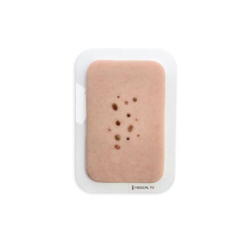 Pocketwunde Melanozytärer Nävus (Muttermal)