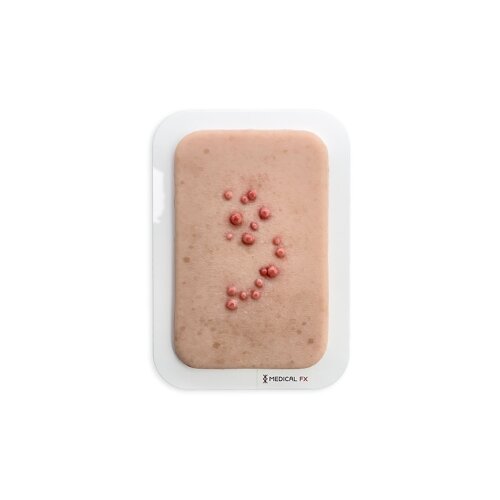 Pocketwound Molluscum contagiosum (Dell wart)