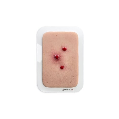 Pocket Wound Granuloma pyogenicum